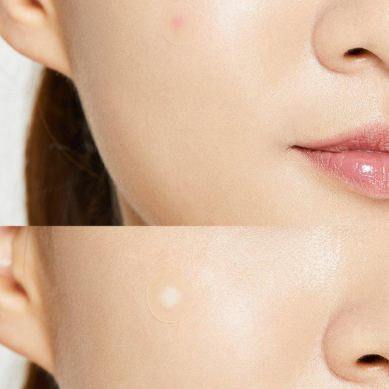 COSRX Acne Pimple Master Patch before and after
