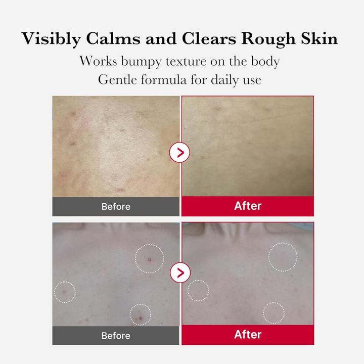 Medicube Red Acne Body Peeling Shot 110g
