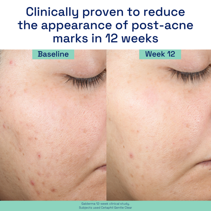 Cetaphil Gentle Clear Repairing Post-Acne Serum 30ml