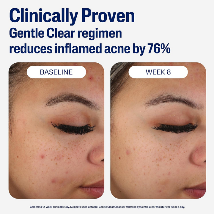 Cetaphil Gentle Clear Mattifying Acne Moisturizer