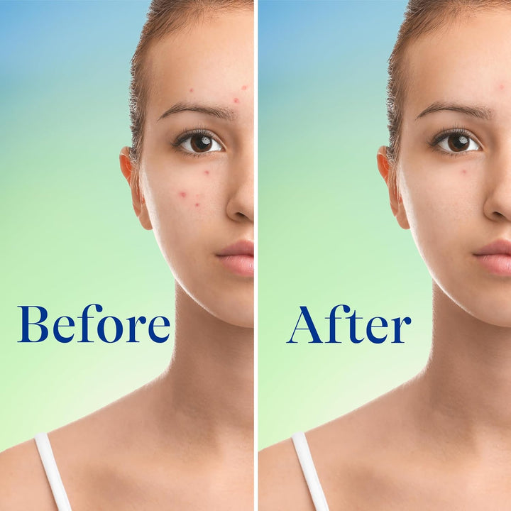 Differin 10% Benzoyl Peroxide Maximum Strength Acne Foaming Cleanser 148ml