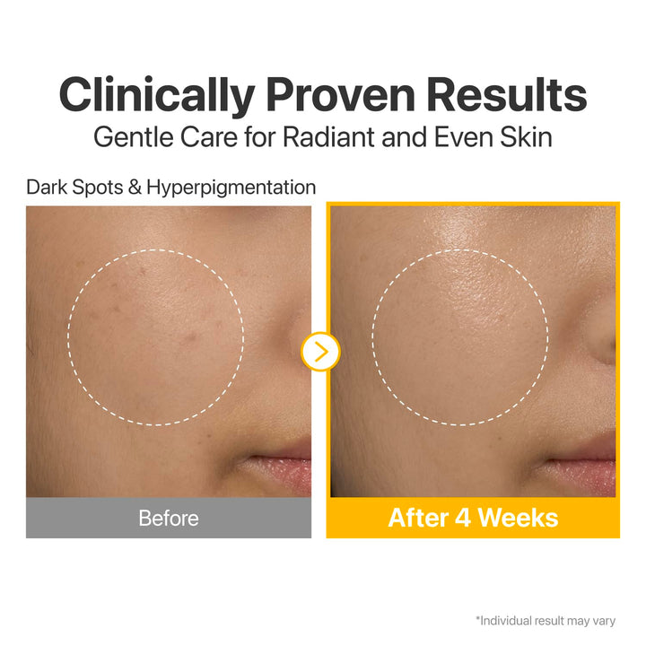 glutathione with vitamin c before and after Glutathione IV in Fort Myers, FL