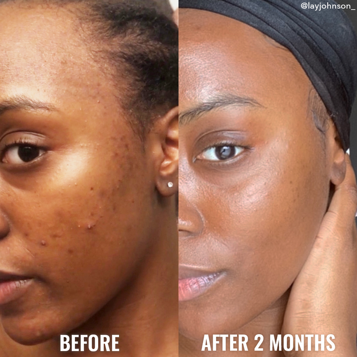 Good Molecules Discoloration Correcting Serum BEFORE AND AFTER 2