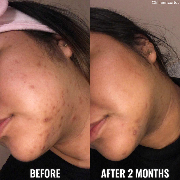 Good Molecules Discoloration Correcting Serum BEFORE AND AFTER 3