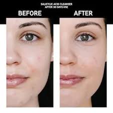 The INKEY List Salicylic Acid Acne + Pore Cleanser